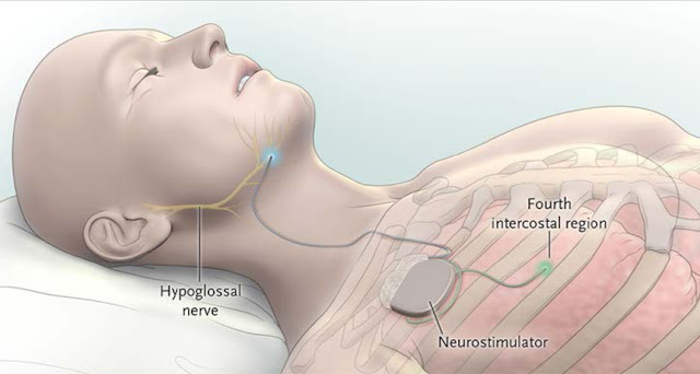 Ns Apnea Implant.jpg
